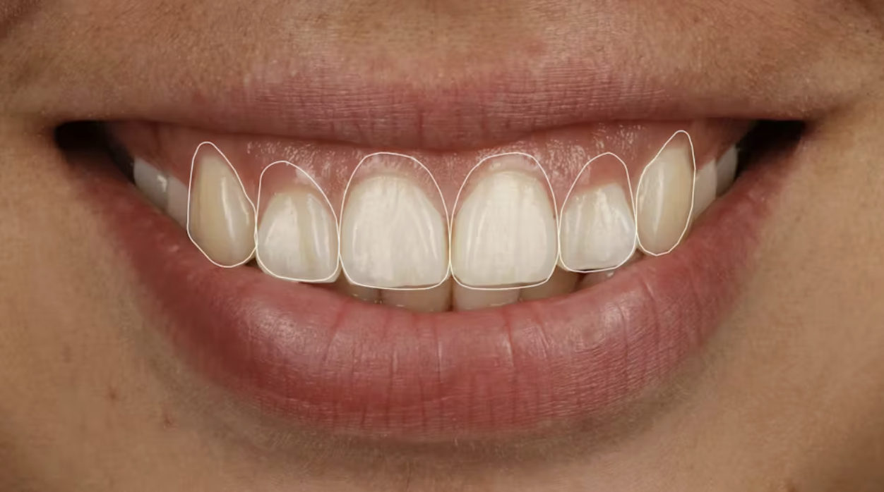 Xác định vị trí đường viền nướu trong thiết kế nụ cười nha khoa